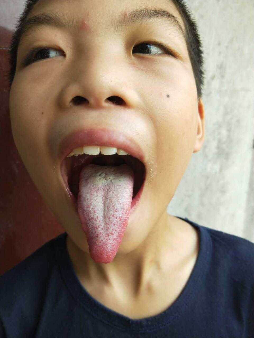 肠胃湿热有什么症状怎样调理,肠胃湿热