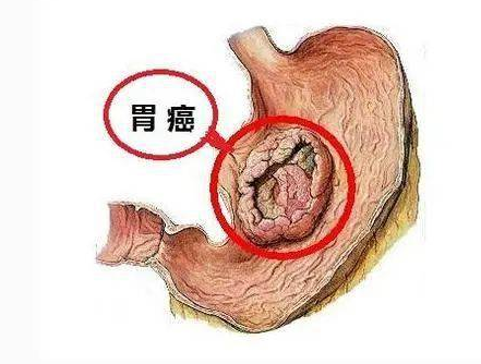 胃息肉胃息肉怎么治疗才消除