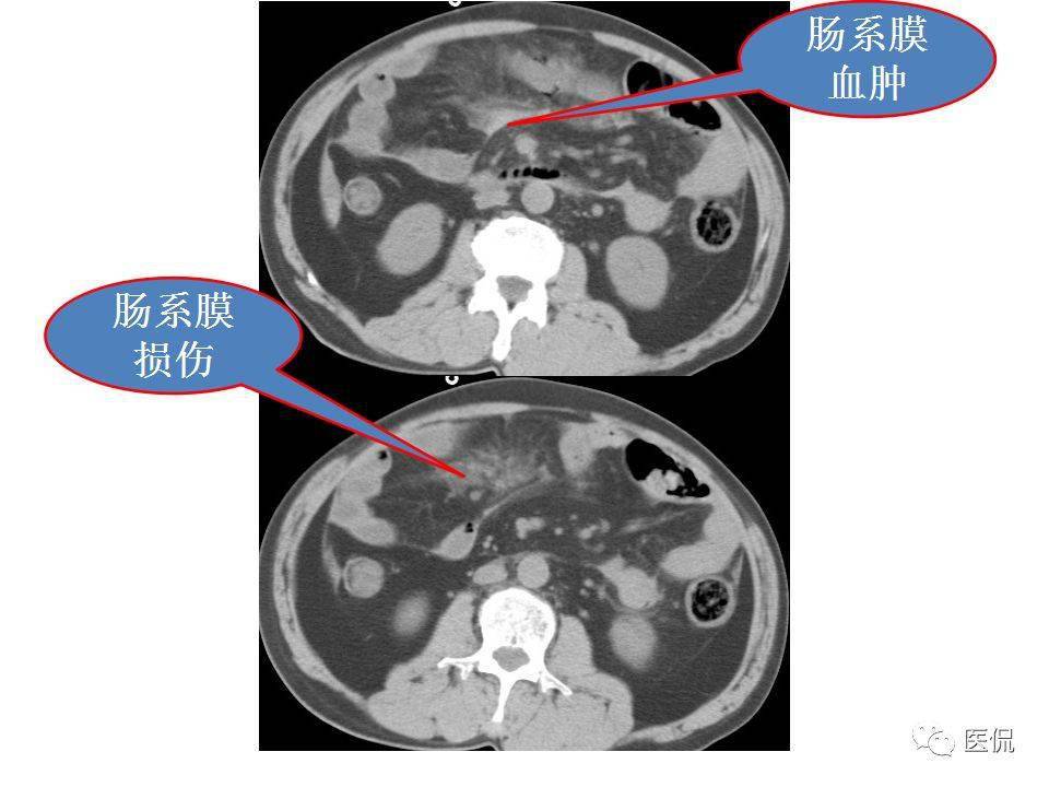 肠系膜,肠系膜淋巴结炎