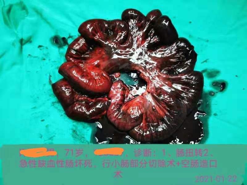 肠梗阻的症状,肠梗阻的症状严重后果