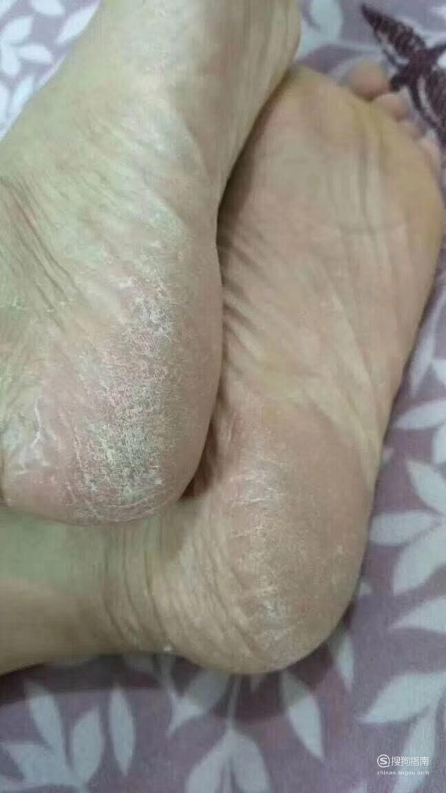 睡觉晚上老是脚底出汗晚上睡觉脚底出汗什么情况