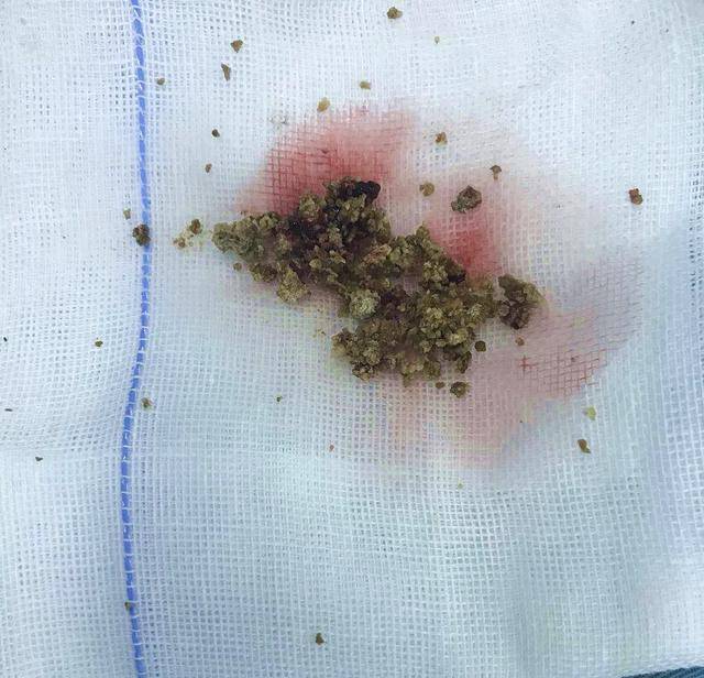 结石,结石是怎么引起的原因