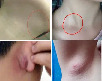 睡觉起来淋巴结疼痛,睡觉起来淋巴结就变大