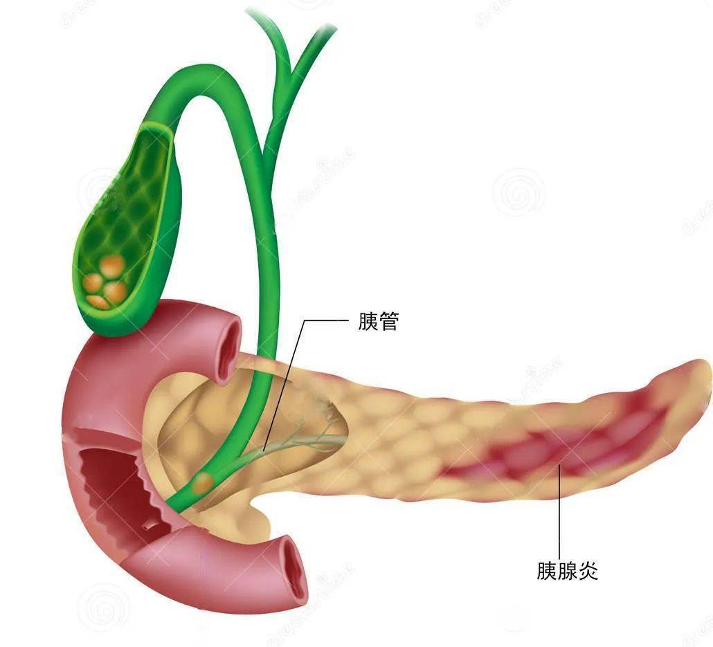 胰腺炎的症状有哪些表现胰腺