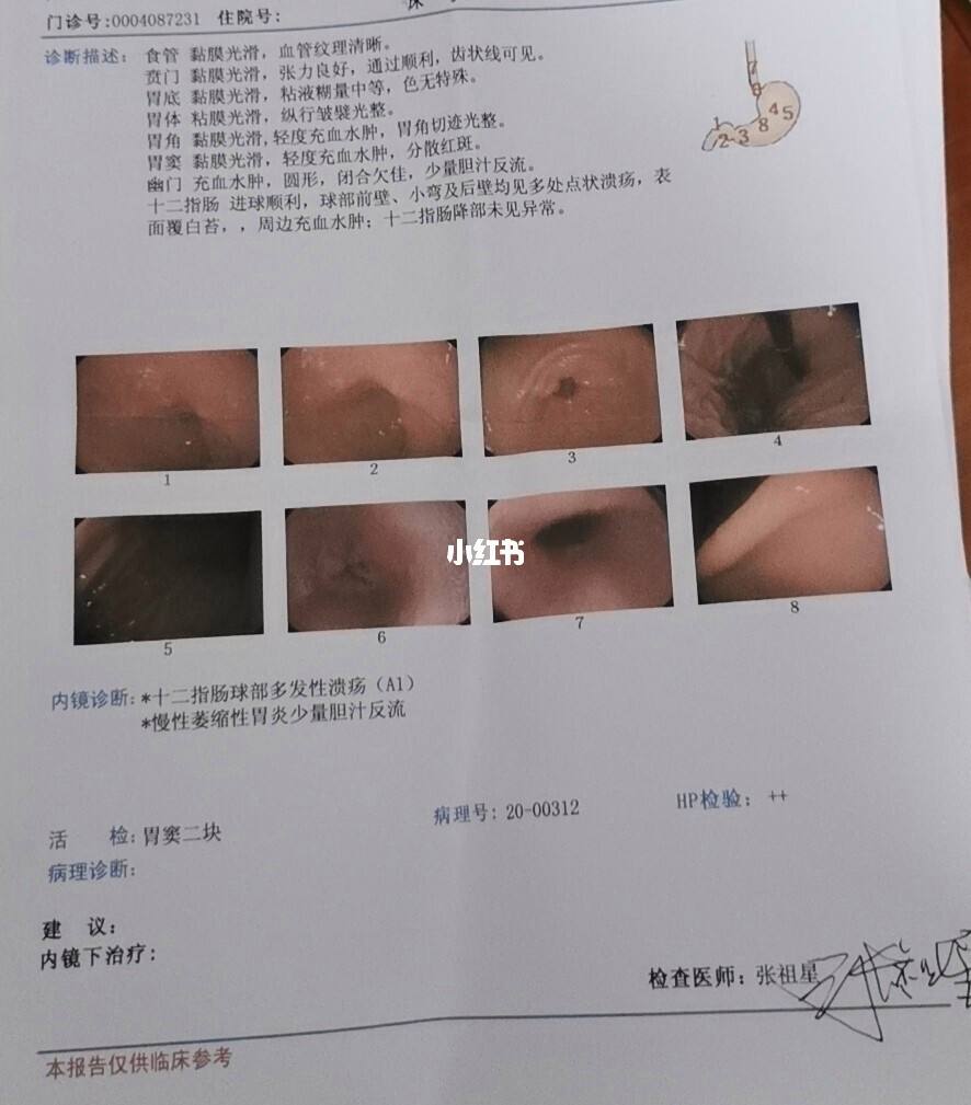 十二指肠球部溃疡有哪些症状,十二指肠球部溃疡