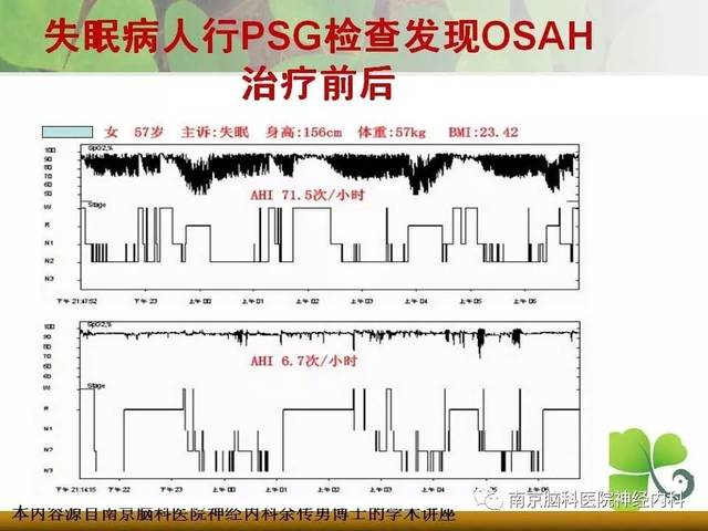 睡眠监测挂哪个科医院睡眠监测是怎样做的