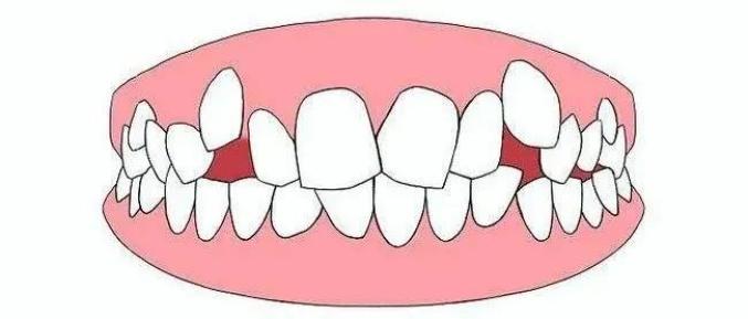 成人晚上磨牙是什么原因引起的睡觉磨牙是四种大病的预兆