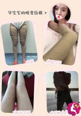 吸脂大腿减肥视频教程,吸脂大腿减肥