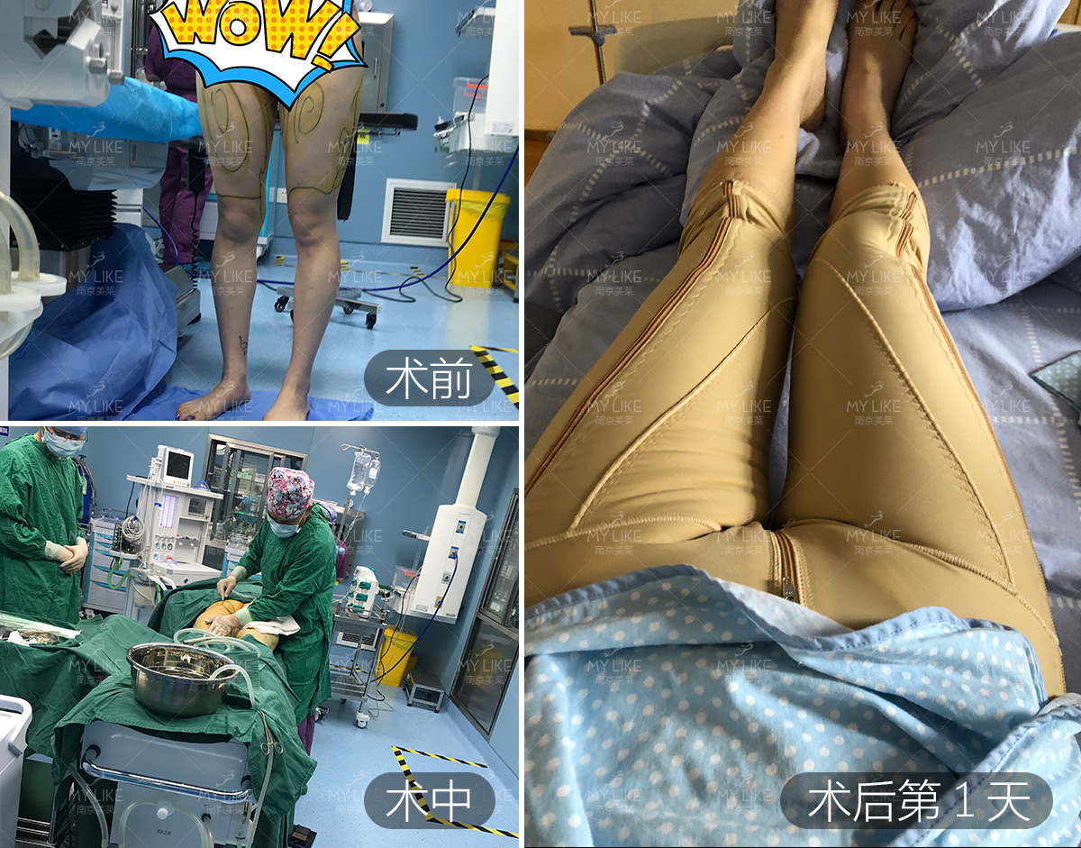 吸脂大腿减肥视频教程,吸脂大腿减肥