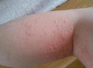 甲醛中毒是什么症状,甲醛中毒是什么症状?