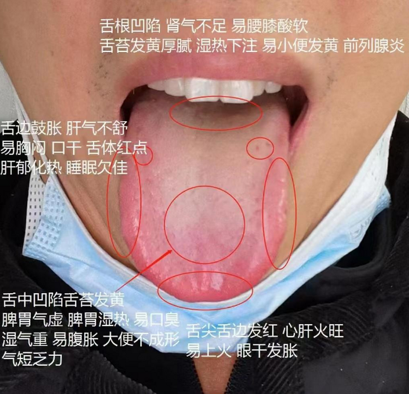 肝阳上亢阴虚内热的症状阴虚内热的症状