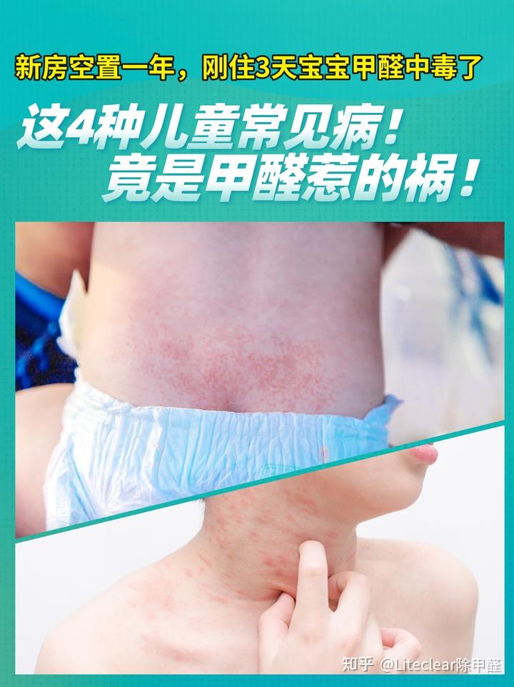 吸入甲醛会有什么症状,宝宝吸入甲醛会有什么症状