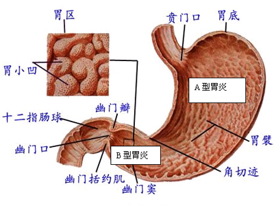 怎么确定是肠胃炎,急性肠胃炎的症状