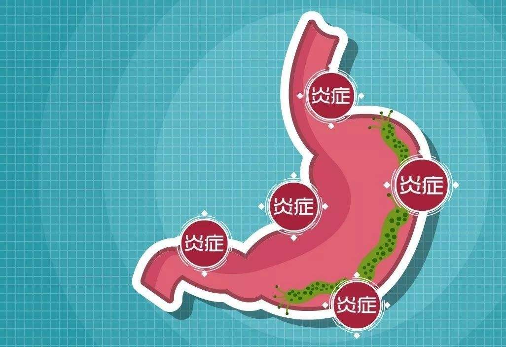 关于有螺旋杆菌会传染给家人吗的信息