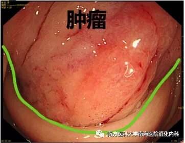 胃出血症状有哪些胃出血前兆是什么症状