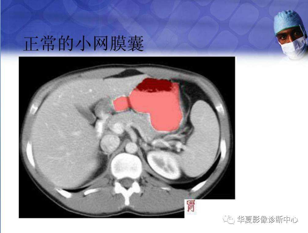 胃穿孔十个漏九个死消化道穿孔