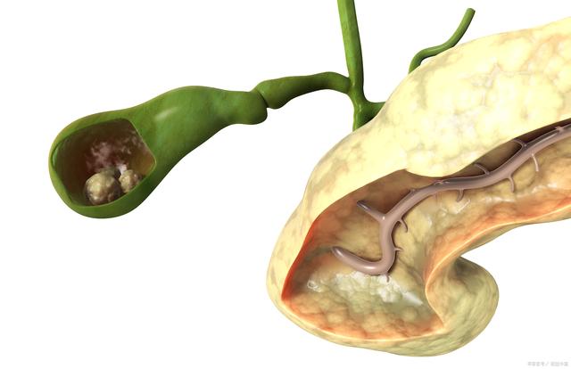 胆囊息肉怎么治疗最好的方法的简单介绍