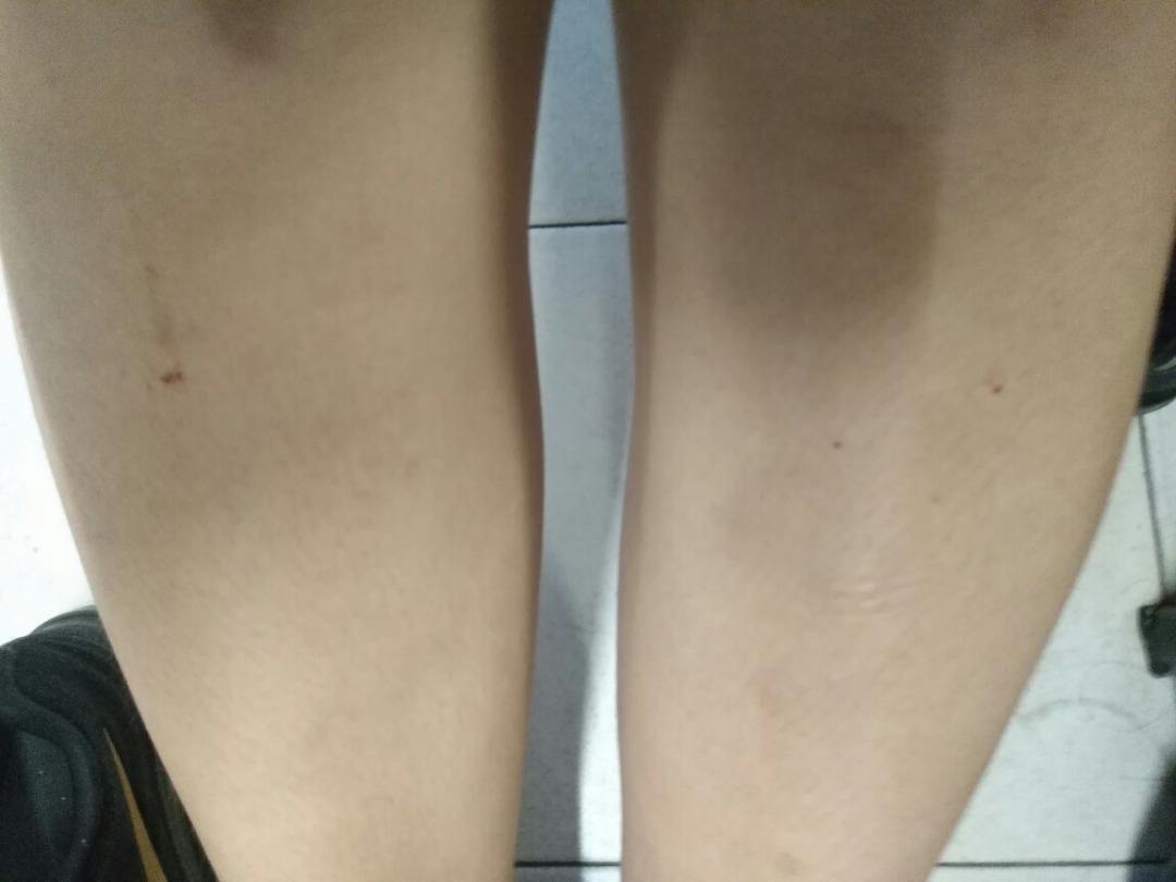 全身埋线减肥会痛几天,针灸减肥埋线减肥