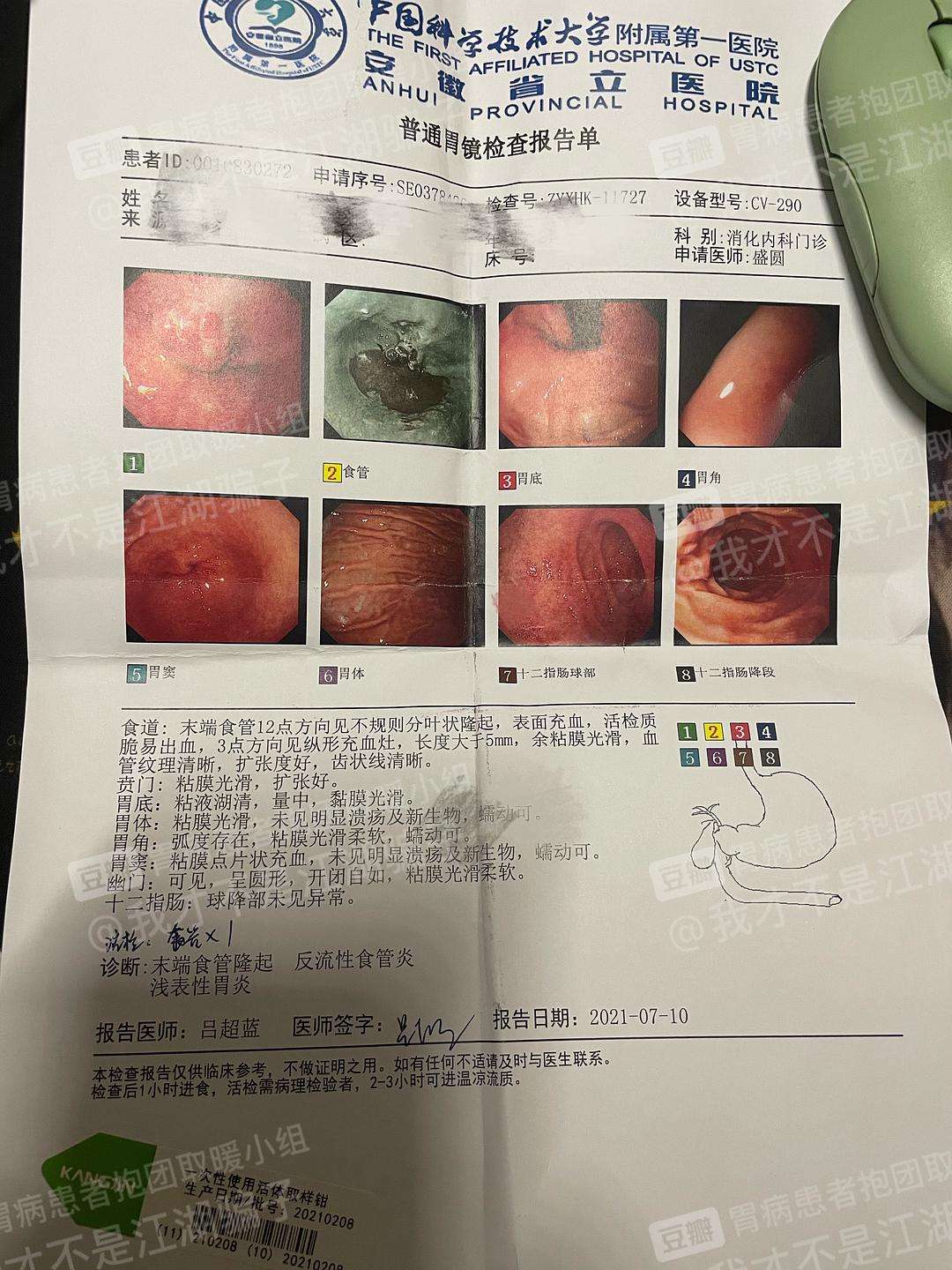 胃息肉,胃息肉一定要手术吗