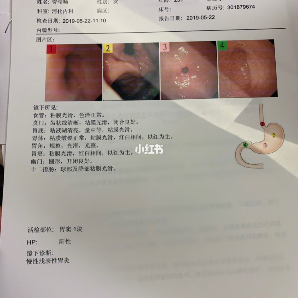 包含幽门螺旋杆菌筛查要空腹吗的词条