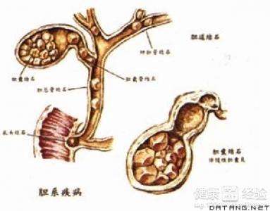 胆囊炎的症状是哪里疼的简单介绍
