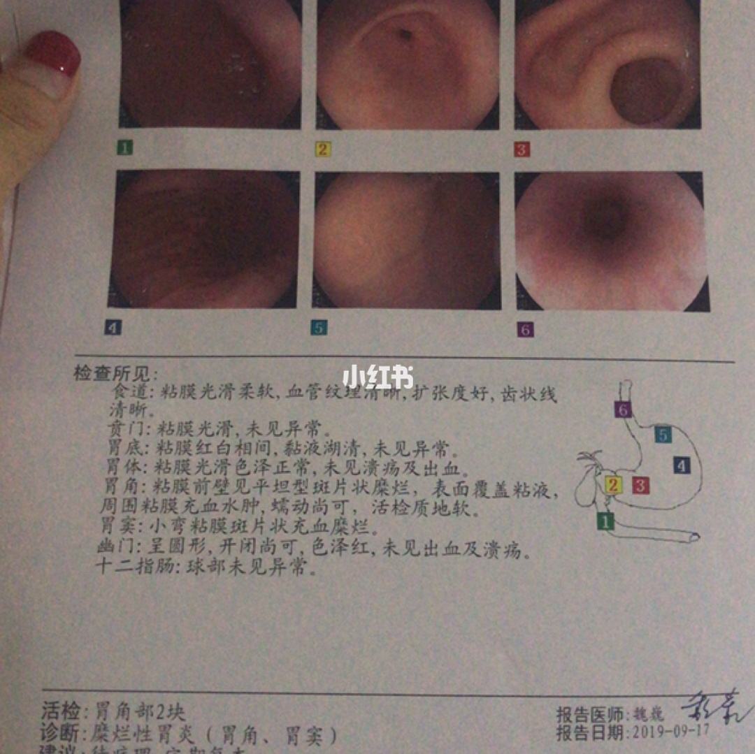 无痛胃镜多少钱做一次无痛胃镜