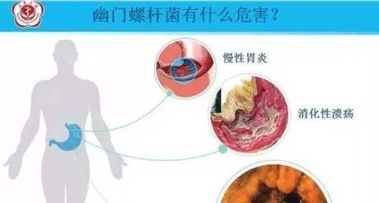 包含幽门螺旋杆菌感染什么症状的词条