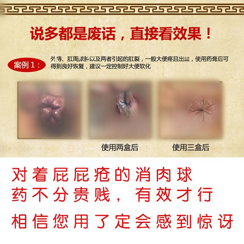 肛裂涂什么药膏能愈合,肛裂出血怎么治愈