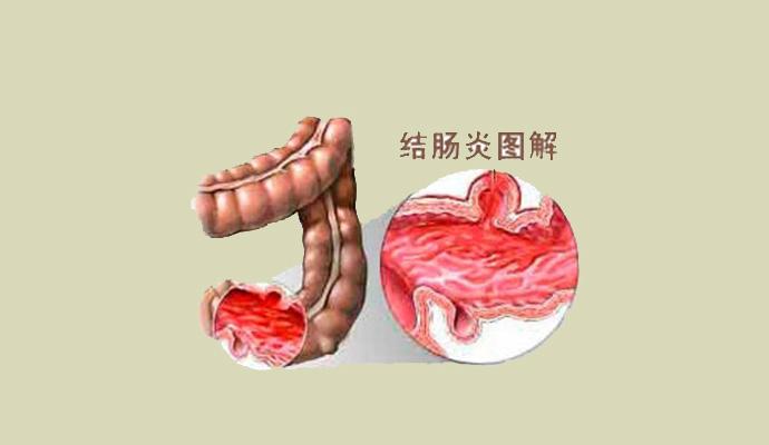 三个征兆说明已有肠癌肠炎