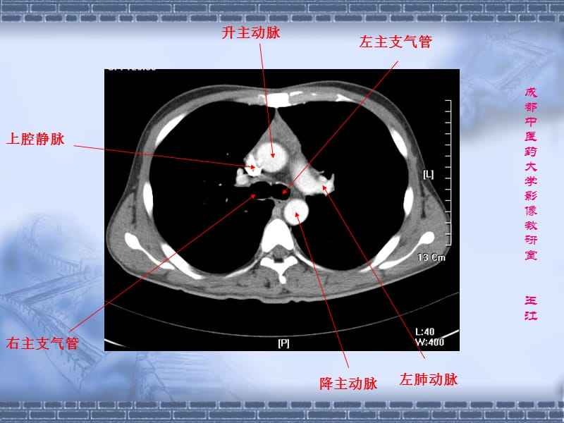 纵隔,纵隔子宫