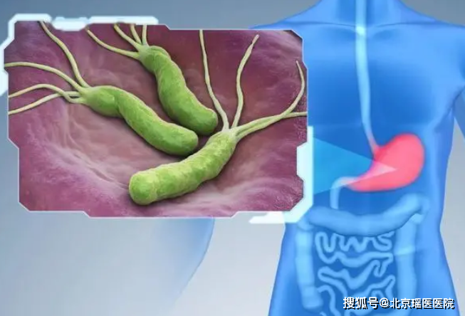 幽门螺旋杆菌超标需要治疗吗幽门螺旋杆菌超标一点点要治吗