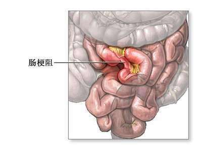 腹痛腹胀腹痛腹胀恶心消化不良