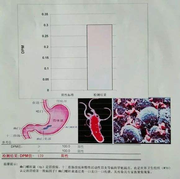 关于幽门螺旋杆菌阳性用不用治疗的信息