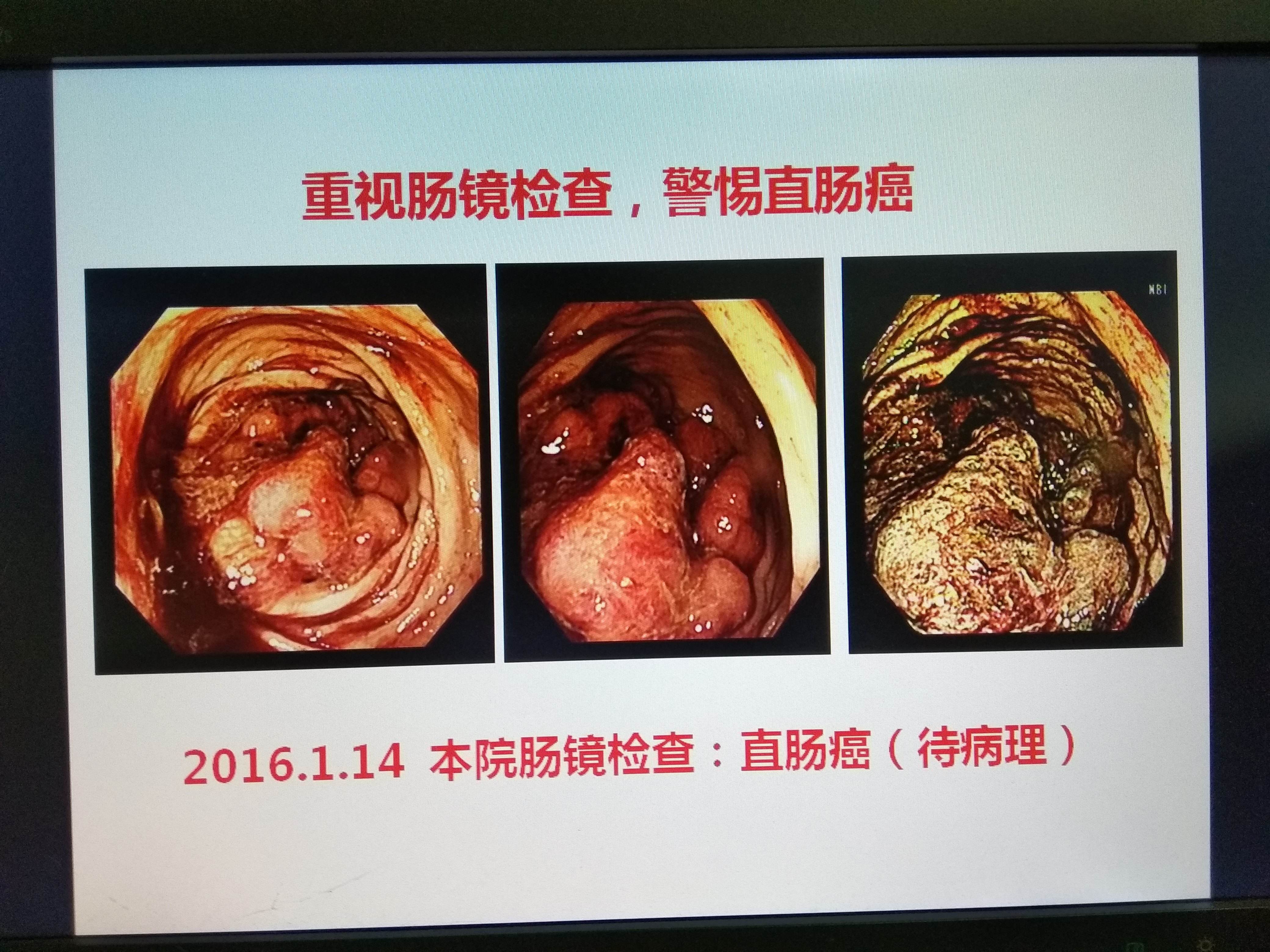 直肠癌,怎么区分痔疮出血和肠道出血