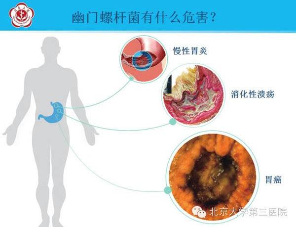 家里一个人查出幽门螺旋杆菌感染幽门螺杆菌有什么症状