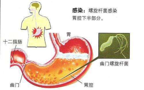 幽门杆菌有什么症状有些,幽门螺旋杆菌的症状有哪些