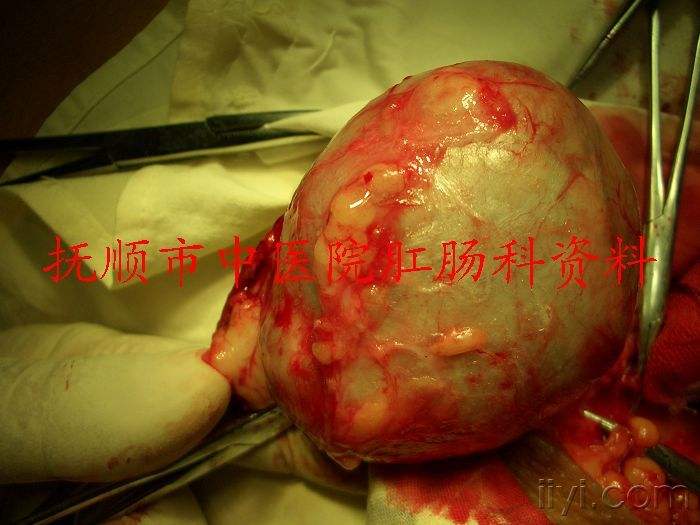 肛周潮湿用什么药膏,肛门潮湿
