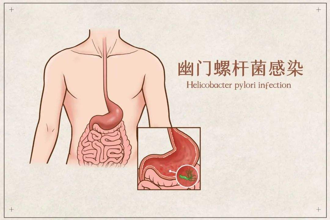 幽门螺旋杆菌的症状及危害的简单介绍