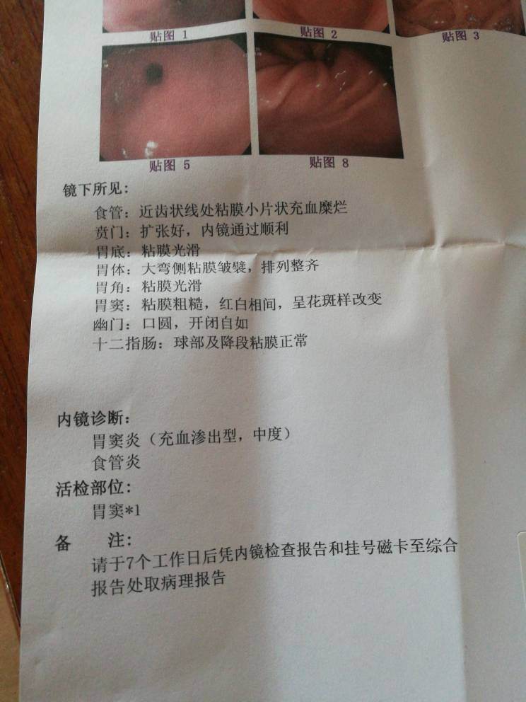 食管炎,食管炎会引起胸痛吗
