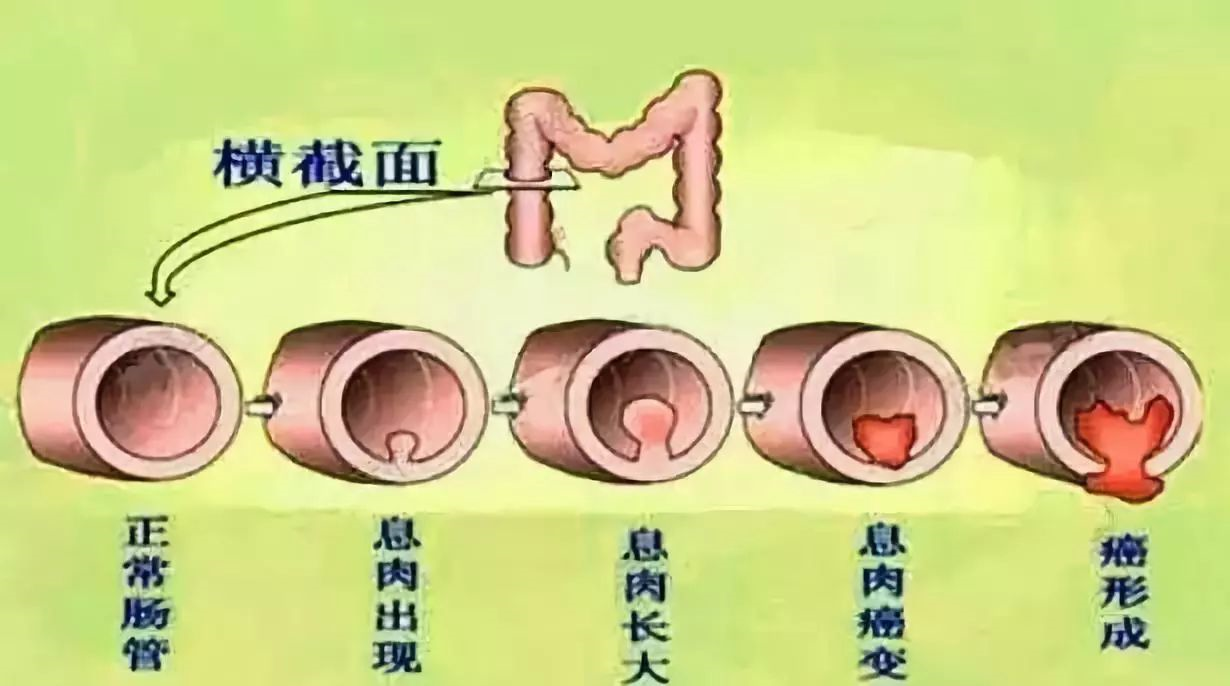 息肉,为什么会长息肉