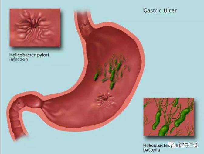幽螺门杆菌阳性要紧吗,幽门螺旋杆菌