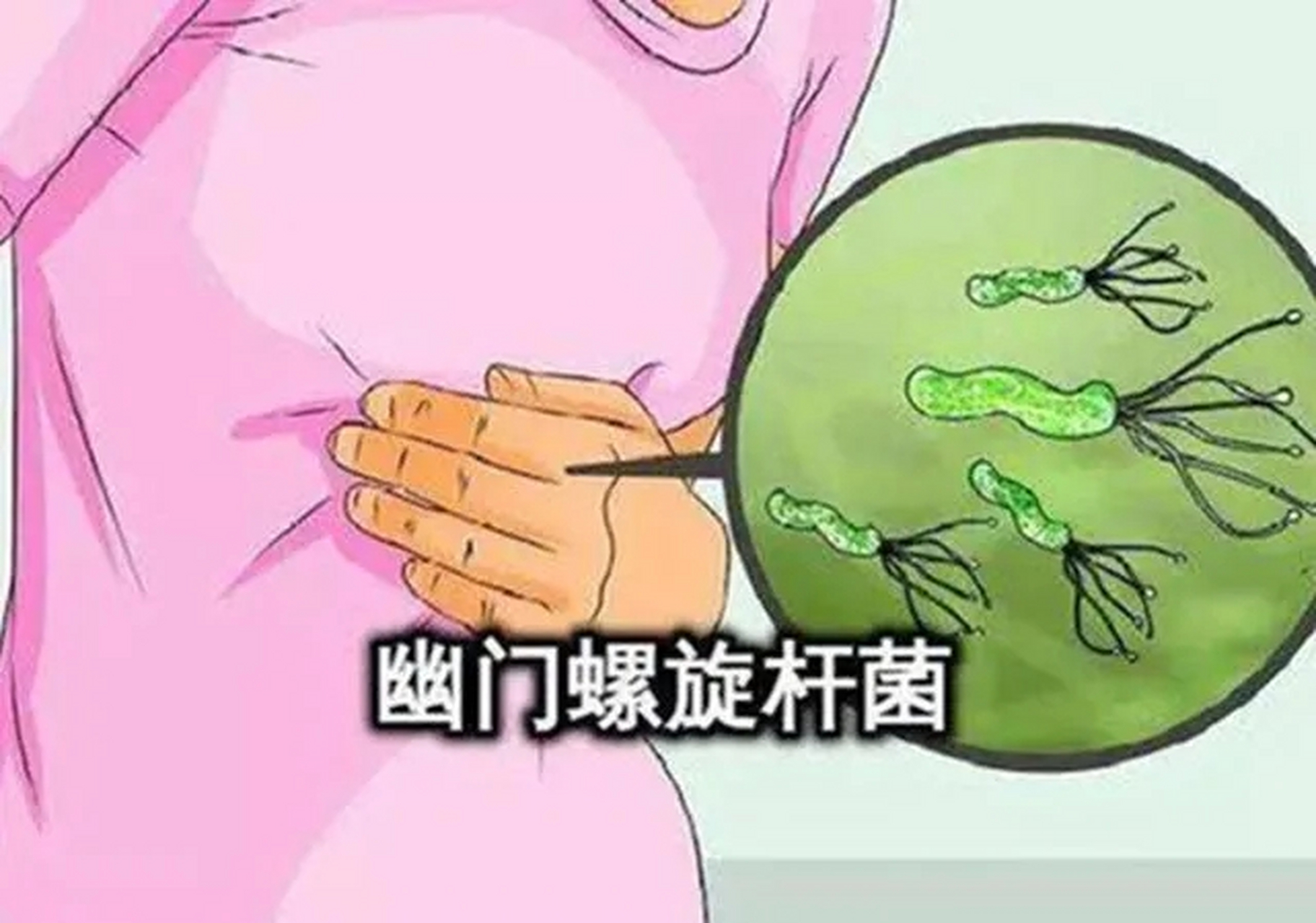 幽旋罗门杆菌有哪些症状幽门螺旋杆菌最好的治疗方法