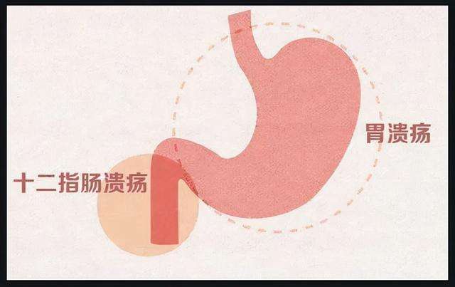 幽门杆菌如何治疗幽门螺杆菌最怕的食物