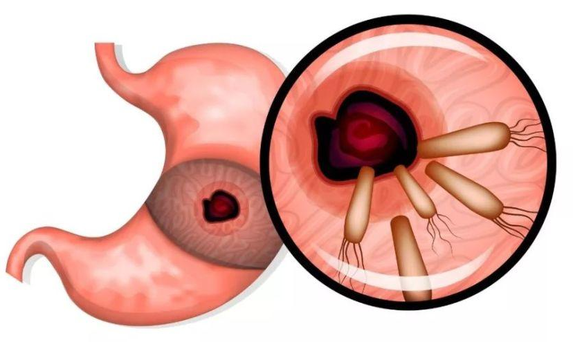 幽门螺旋杆菌是怎样引起的的简单介绍