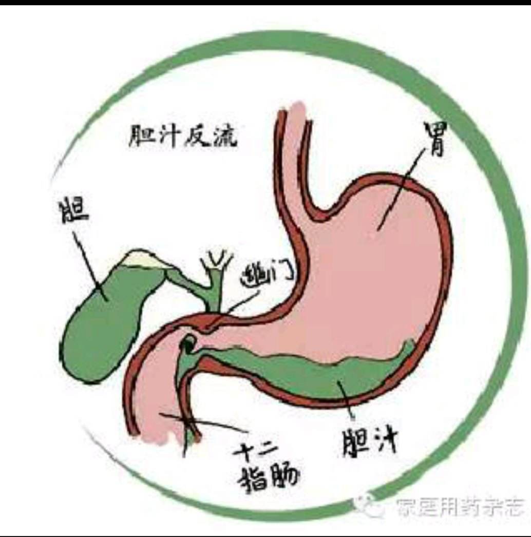 为什么胆汁反流病晚上会严重,胆汁反流性胃炎吃什么药