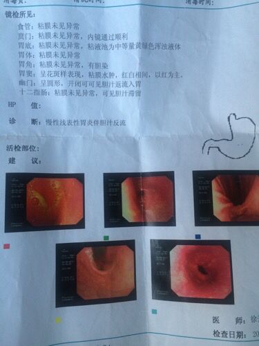 浅表性胃炎伴糜烂浅表性胃炎伴糜烂贲门松弛