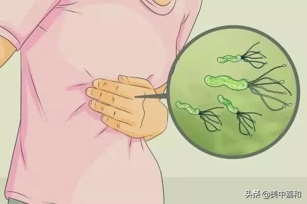 幽门螺旋杆菌阳性2个严重吗 幽门螺旋杆菌阳性2个严重吗
