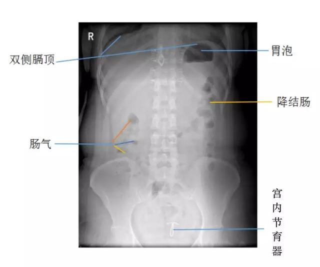 消化道穿孔 消化道穿孔