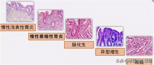 浅表性胃炎的症状 浅表性胃炎的症状