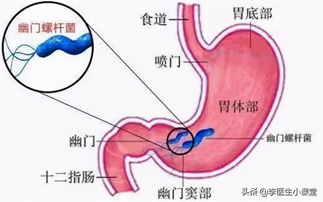 浅表性胃炎的症状 浅表性胃炎的症状